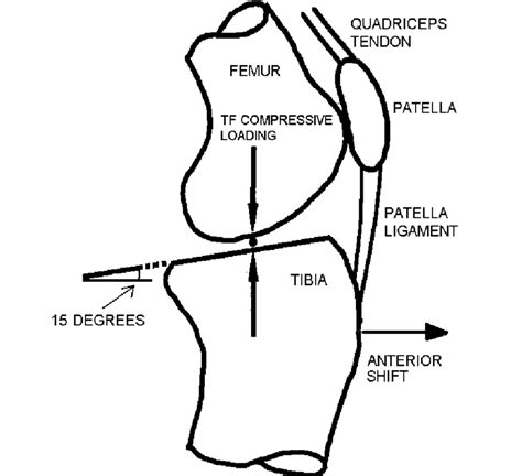 14 Tilt Of The Tibial Plateau And Anterior Displacement Of The Tibia