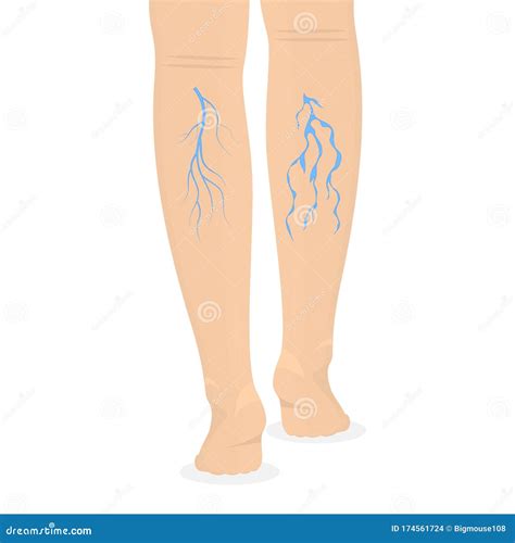 Cartoon Color Human Legs And Varicose Veins Vector Stock Vector