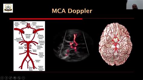 Middle Cerebral Artery Doppler Prof Gilani S Lectures Youtube