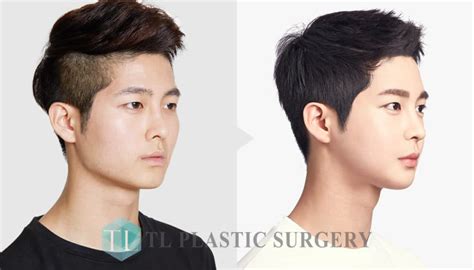Korean Guys Before And After Plastic Surgery