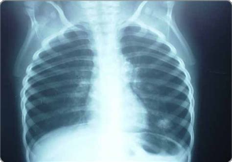 Tuberculosis Ganglionar Intratorácica Parahiliar Izquierda Y Granuloma