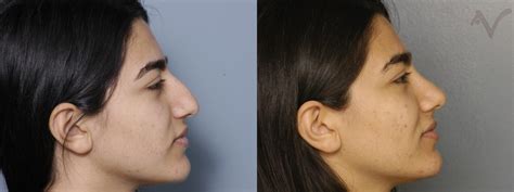 Rhinoplasty Before And After Pictures Case 327 Los Angeles Ca
