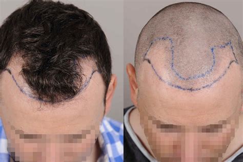 Methoden Der Haartransplantation Fue Und Fut Technik Im Berblick