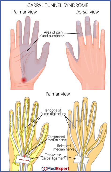 Carpal Tunnel Syndrome Med Expert