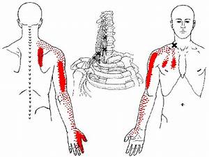 Scalene Trigger Points And Referred Patterns