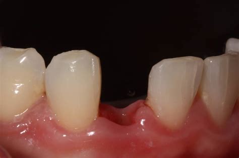 Dental Implant Case Spath Dentistry