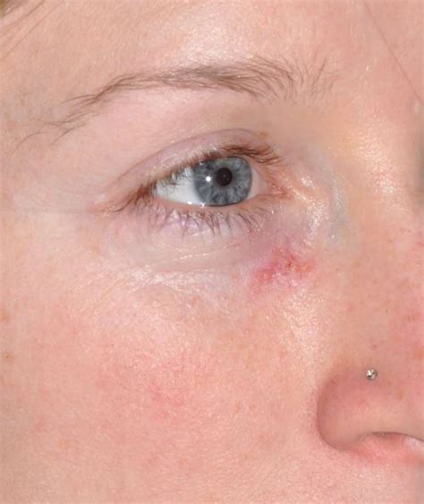 List 90 Pictures Photos Of Skin Cancer On Face Sharp 102023