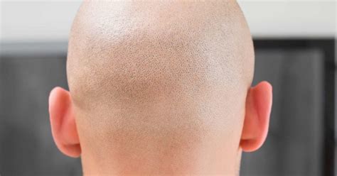 Alopecia Totalis Symptoms Treatments And Types