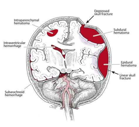 Traumatic Brain Injury Nurse Key