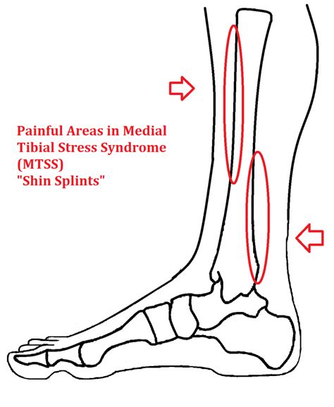 Medial Tibial Stress Syndrome Prevention