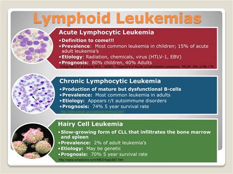 Ppt Acute Lymphoblastic Leukemia An Overview Powerpoint Presentation Be7