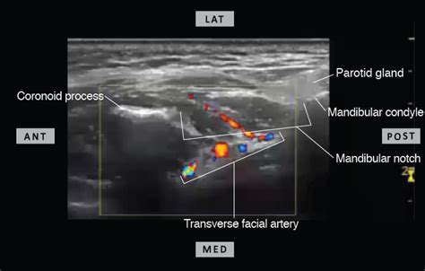 Ultrasound Guided Maxillary Nerve Block Via The Pterygopalatine Fossa