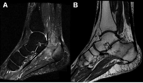 Mri Sagittal Image With Stir Short Ti Inversion Recovery Sequence