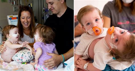 One Year Old Conjoined Twins Successfully Separated In 11 Hour Surgery