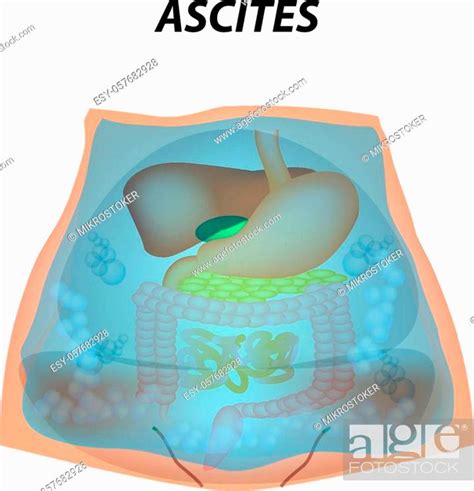 Ascites Free Fluid In The Abdominal Cavity Infographics Stock Vector