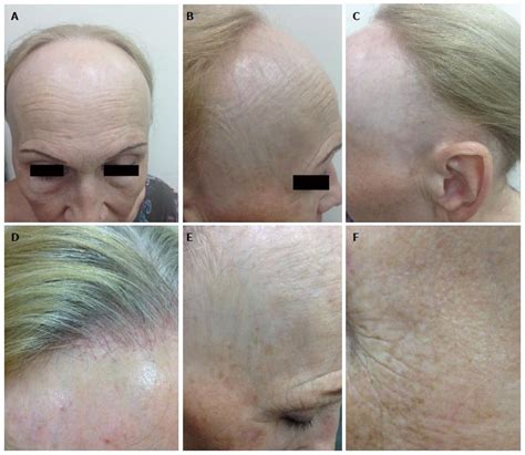 Frontal Fibrosing Alopecia Update