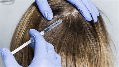 You may have medical problems or taking medication that are causing you to lose hair? Mesotherapy Hair Treatment in Pune - Skin Story Clinic