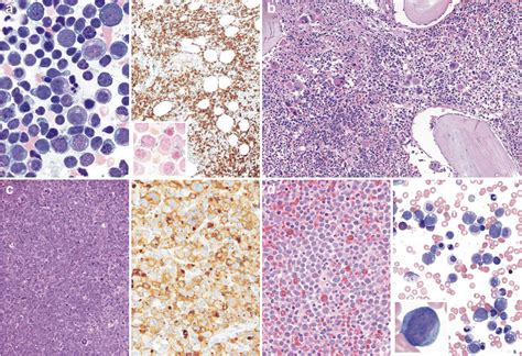 A Acute Myeloid Leukemia Aml With Myelodysplasia Related Changes