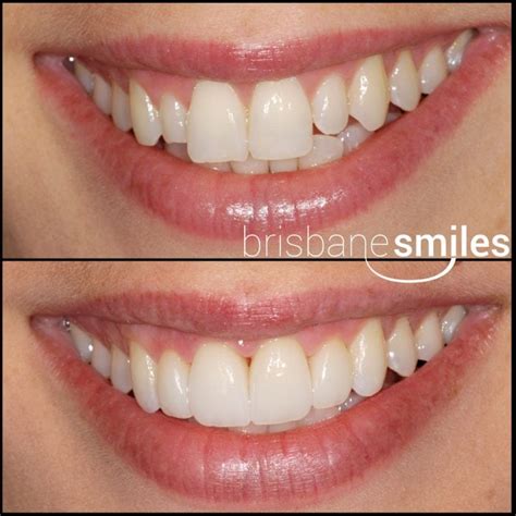 Porcelain Veneers Brisbane Cosmetic Dentist Brisbane Smiles