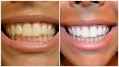 How To Whiten Your Teeth Naturally • Exquisite Magazine Fashion