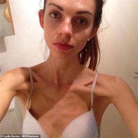 Former Anorexic Whose Weight Plummeted To Six Stone Turns Life Around