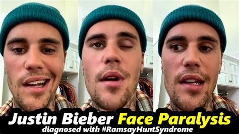 Justin Bieber Suffers From Ramsay Hunt Syndrome Justin Bieber Face Paralysis Tfpc Youtube