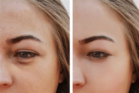 How To Remove Dark Circles Under Eyes Permanently - Fitneass