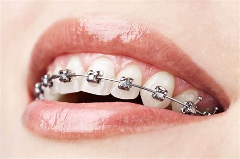 What Causes Buck Teeth Biscayne Dental