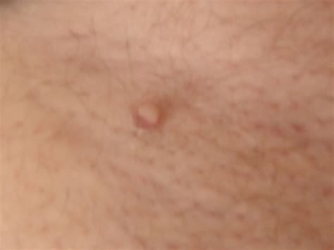 What Is This Thing Hanging From My Armpit Cutaneous Skin Tag Hubpages