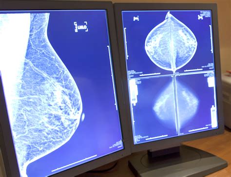 Inflammatory Breast Cancer A Dangerous Aggressive Form Houston Chronicle