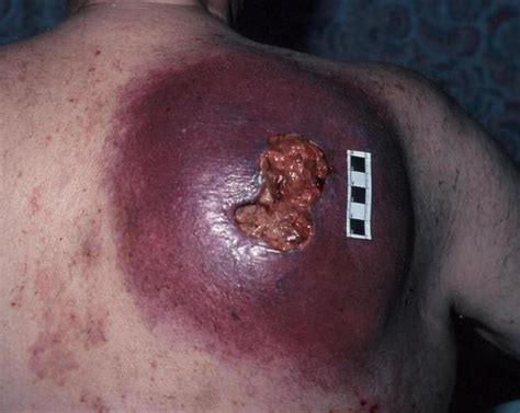 The cancer can look like a pigmented black or brown streak extending the length of your nail. Pictures of Skin Cancer ... Better put Sun-Block in your BOB