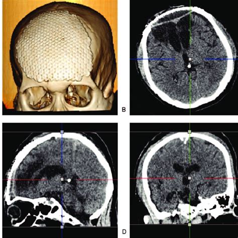 Ct Images After Cranioplasty A D 3d Reconstruction And Thin Slice Ct