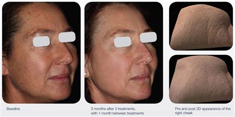 Fractionated Laser For Fine Lines And Wrinkles Qsd