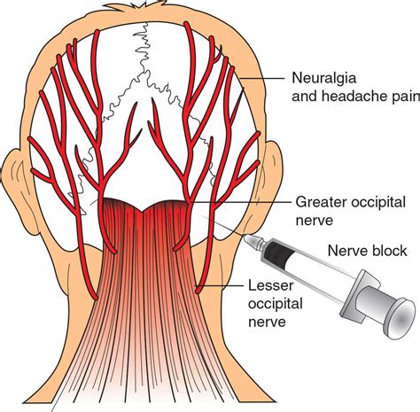 Greater Occipital Nerve And Artery