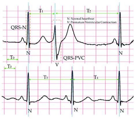 The Waveforms Of Pvc And Normal Heartbeat The Two Ecgs In This Picture