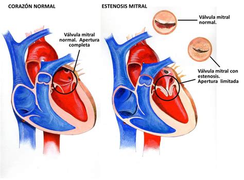 Valvulas Cardiacas Archivos Cardiosaudeferrol