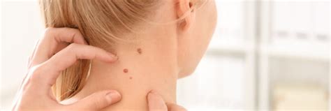 Benign Skin Lesions Westchester Dermatology Medical Clinic