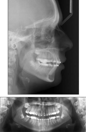 Orthodontic Uprighting Of Severely Impacted Mandibular Second Molars