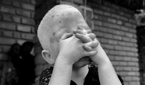 Albinism In Africa Beyond Suncare