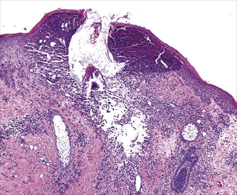 Papulopustular Eruption Associated With Panitumumab Dermatology