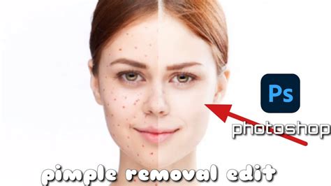 Pimple Removing And Smooth Editing In Photoshopby Avinash Tech To All