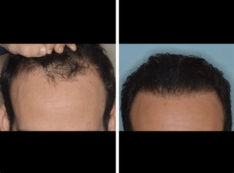 Hair Transplant Dr Anthony Bared Md Facial Plastic Surgeon Dr