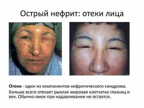 Диета при нефрит почек