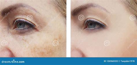 Woman Face Wrinkles Pigmentation Difference Correction Treatment Health