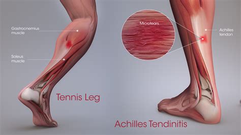 Learn about causes of leg pain, such as trauma, fractures, blood clots, sprains, strains, bleeding, and artery disease. Tennis Leg and Achilles Tendonitis: Confusing The Two Can ...