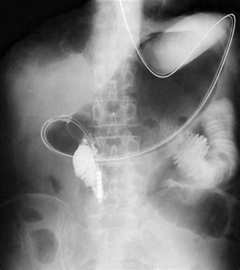 An Ileus Tube Was Placed At The Second Portion Of The Duodenum For The