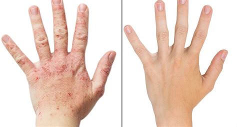 Seborrheic Dermatitis In Adults