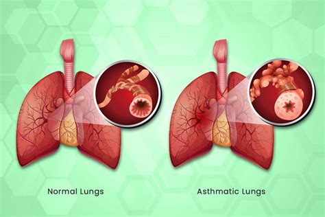 Causes of Asthma and Best Practices for Prevention - mHospital