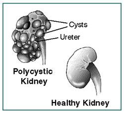 In acute renal diseases it is necessary to establish time of diseases onset, possible connection with previous in/factious diseases. polycystic kidney disease (PKD) | Definition of polycystic kidney disease (PKD) by Webster's ...