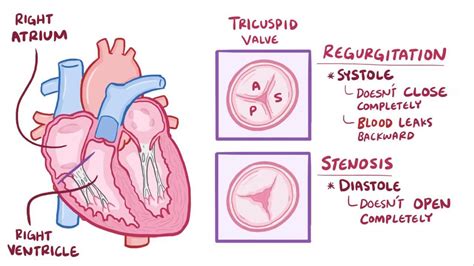 Tricuspid Valve Disease Video Anatomy And Definition Osmosis